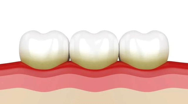 「牙結石」是怎么毀了一口好牙的？